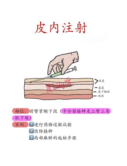 穴位注射的操作步骤