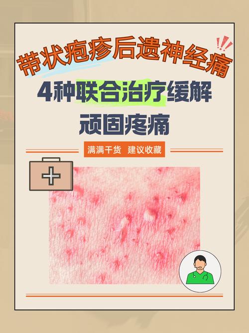 天津中医疱疹就找津门