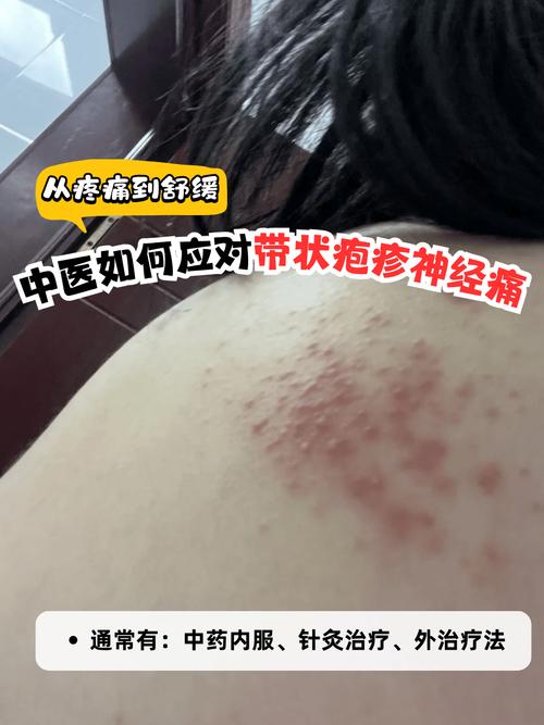 天津中医疱疹就找津门