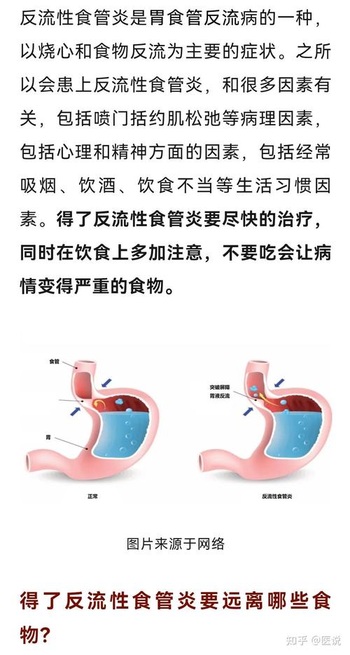 反流性食管炎如何饮食