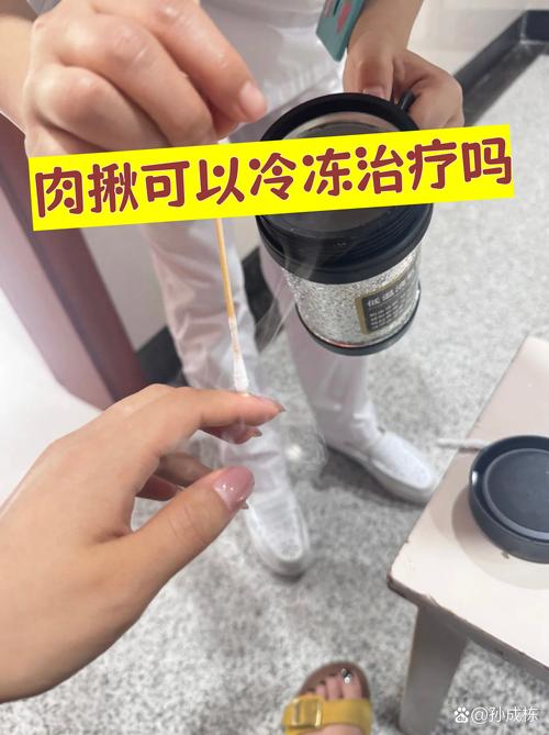 寻常疣冷冻后饮食注意