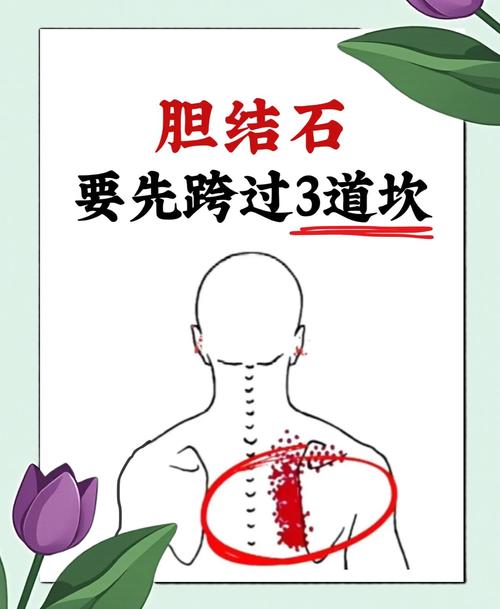 穴位拍打治疗胆结石