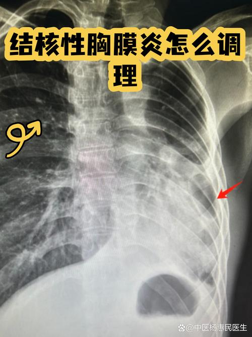 中医治疗结核性胸膜炎