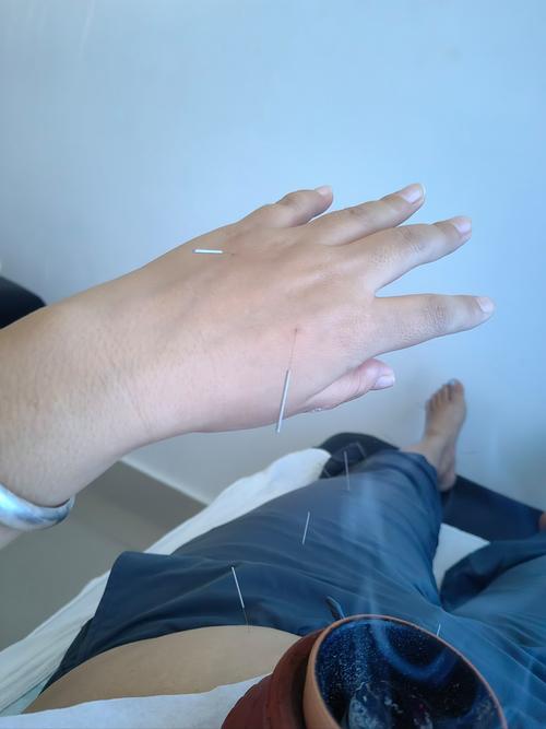 中医院针灸一次200