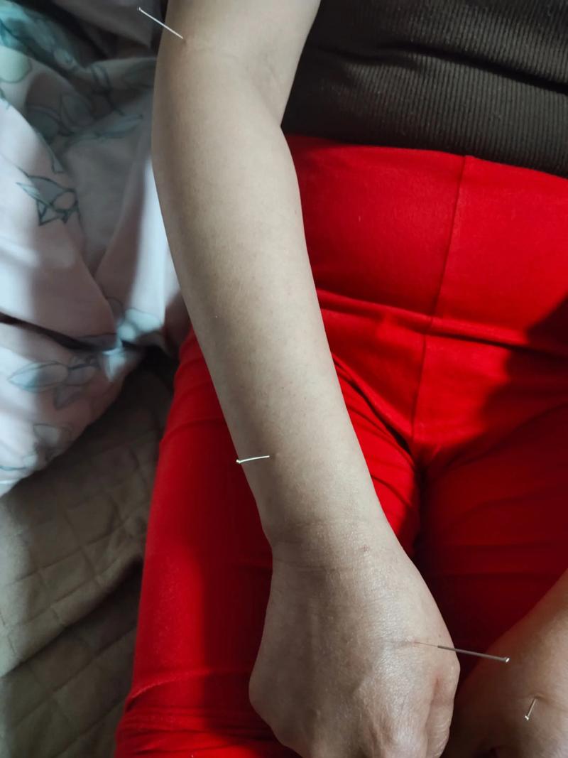 中医院针灸一次200