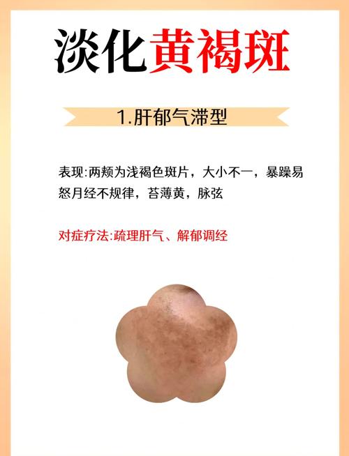 中医治疗黄褐斑有奇效