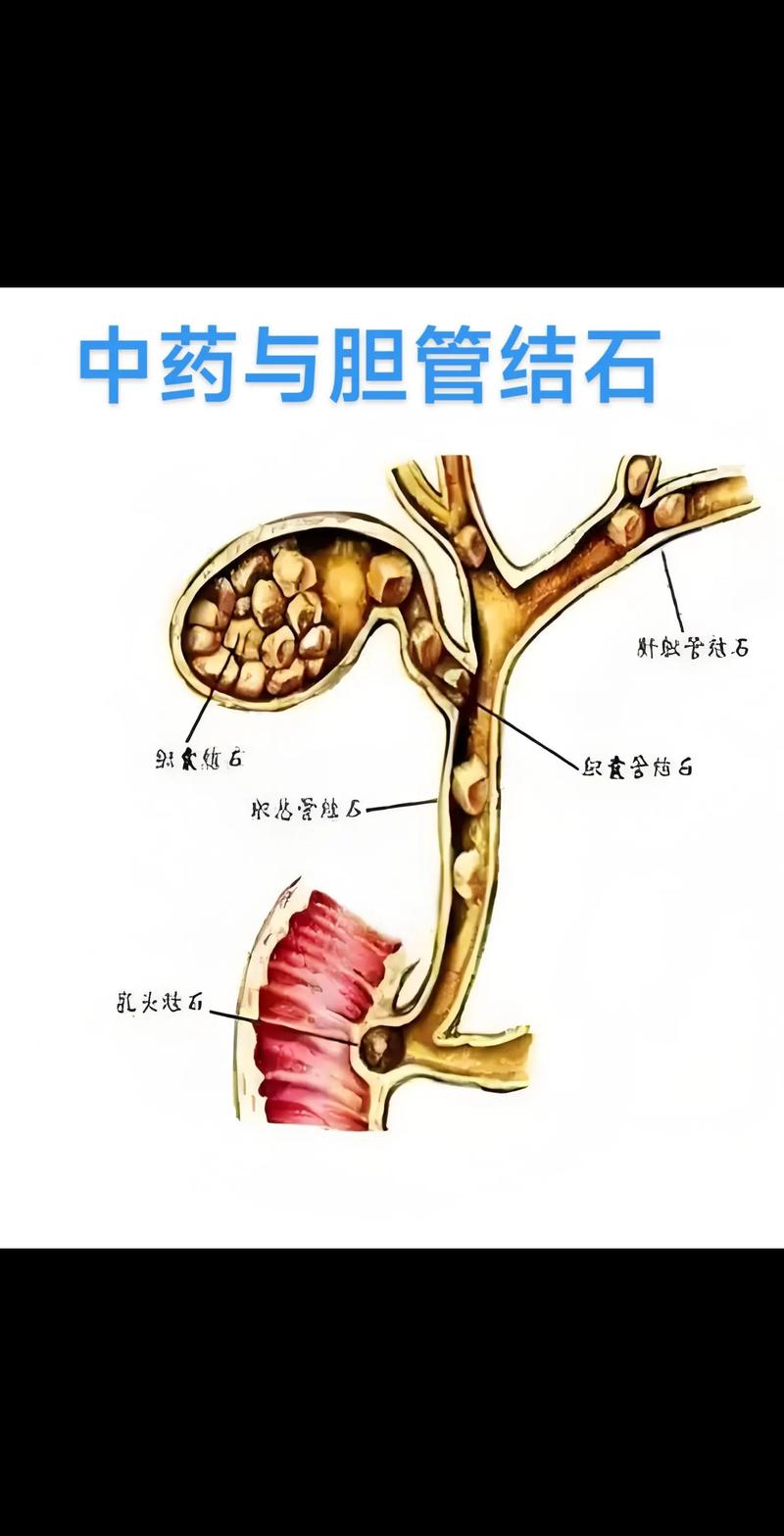 中医治疗胆结石靠谱吗
