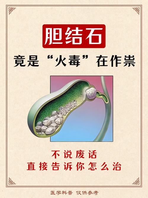 中医治疗胆结石靠谱吗