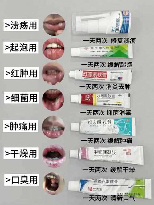 中医治疗口腔溃疡名方