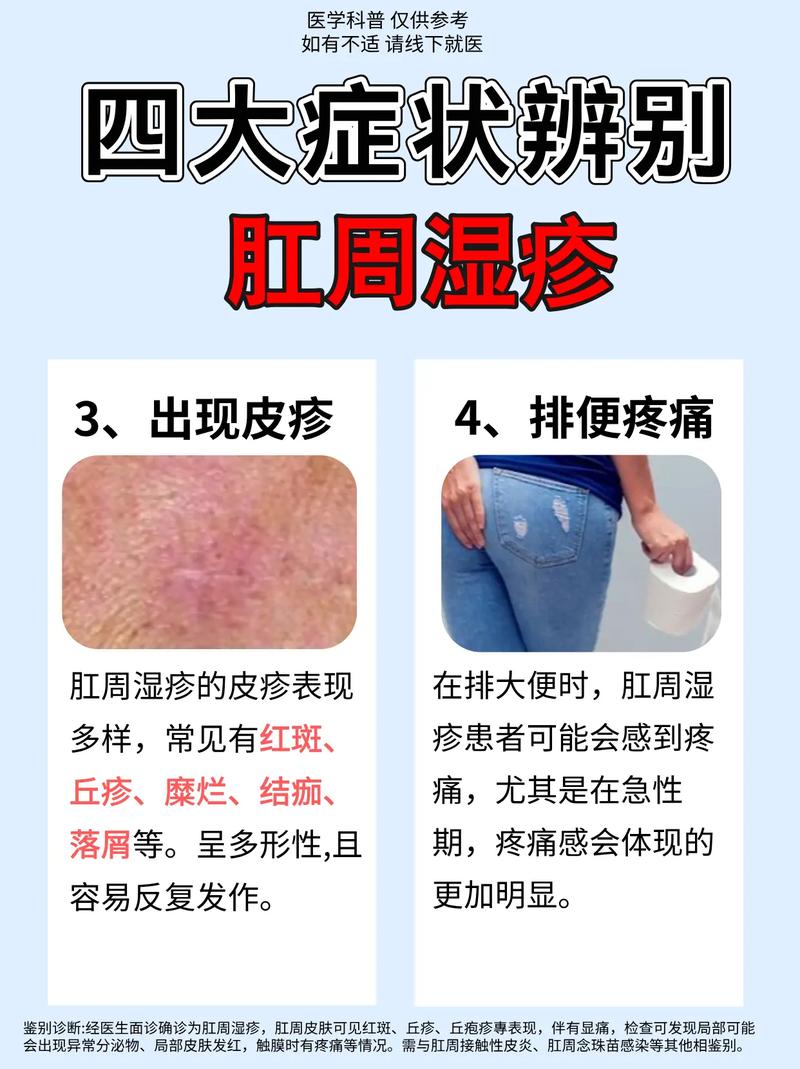 肛周湿疹的饮食 上海