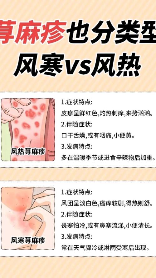 荨麻疹的中医分型治疗