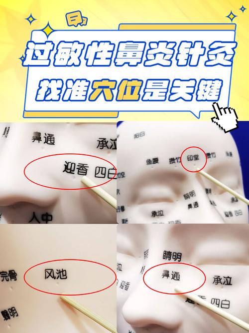 流鼻涕艾灸特效穴位