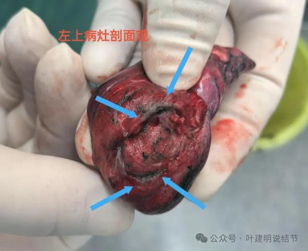 中医治疗肺结节病效果