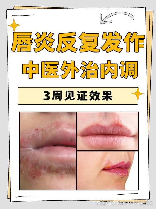 口周皮炎中医怎么治疗