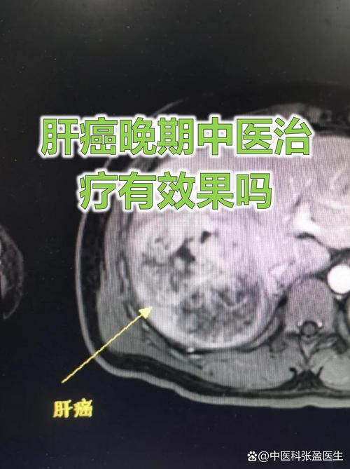 中医能治好肝癌晚期吗