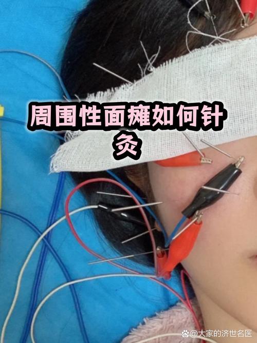 面瘫可以注射穴位针