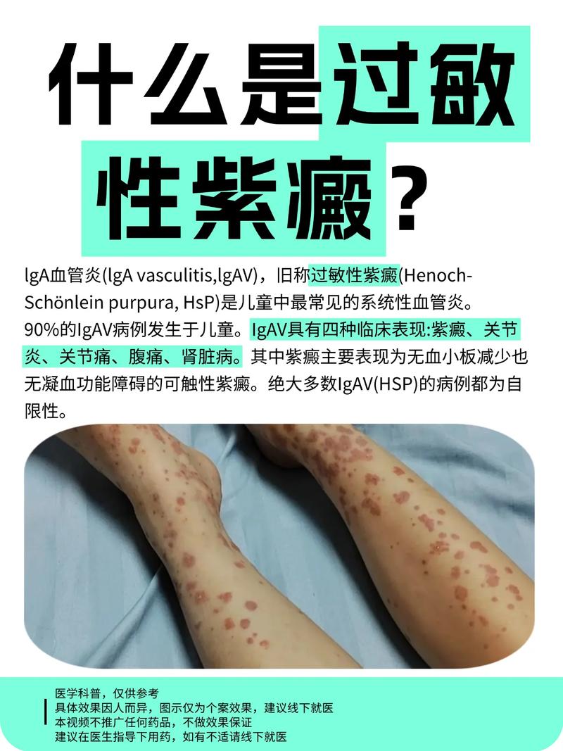 过敏性紫癜的中医病名