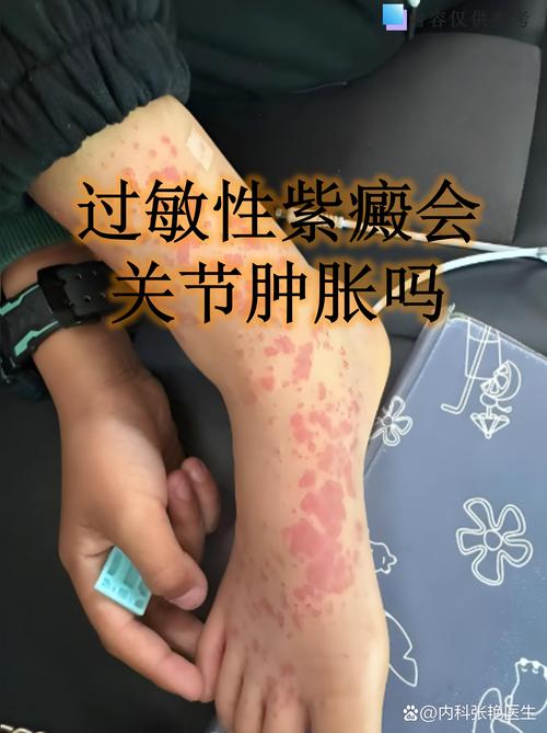 过敏性紫癜的中医病名