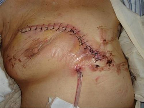 老中医治疗乳腺纤维瘤