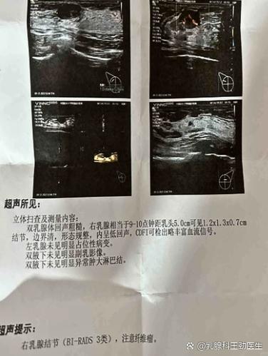 老中医治疗乳腺纤维瘤