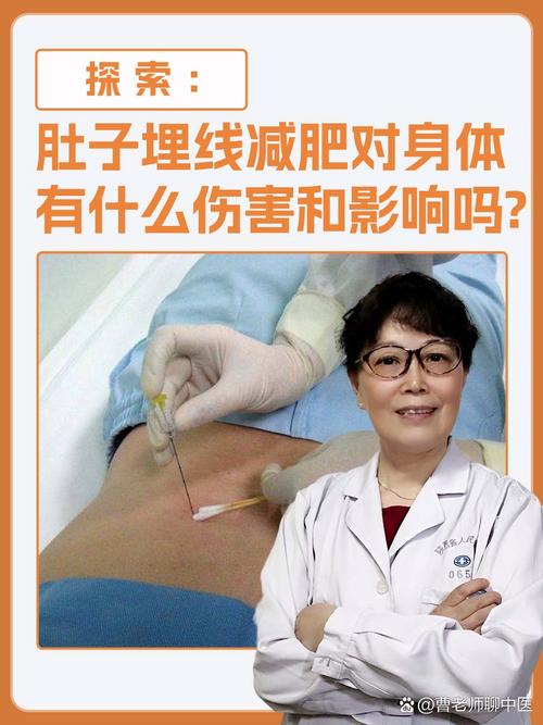江苏省中医院埋线减肥