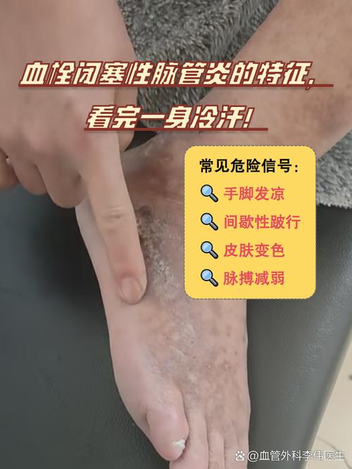 血栓性静脉炎中医病名