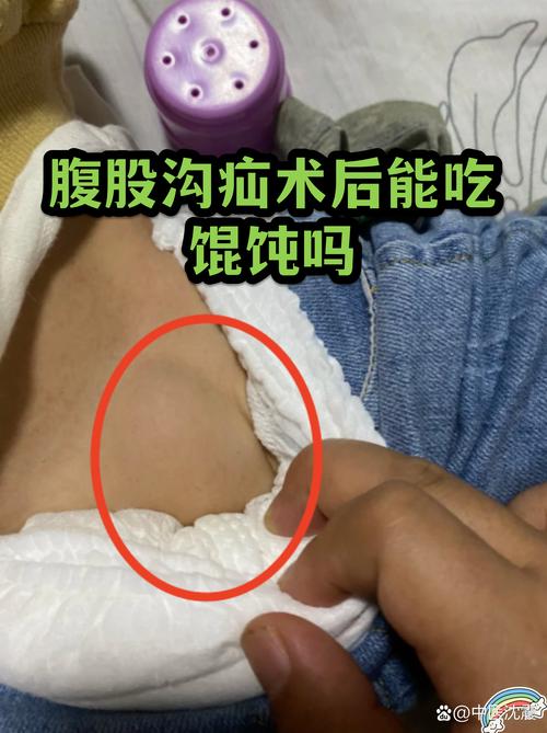 腹股沟疝气手术后饮食