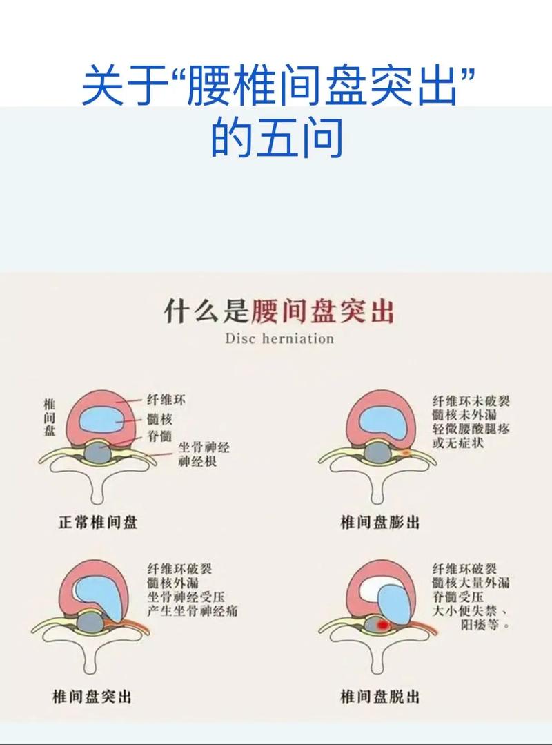腰椎间盘突出中医解释