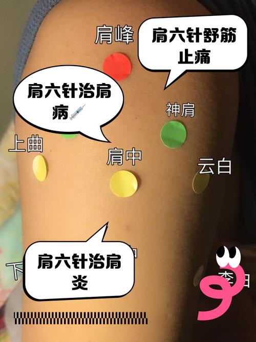 肩关节脱位治疗穴位