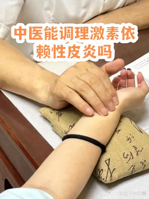 激素性皮炎可以中医吗